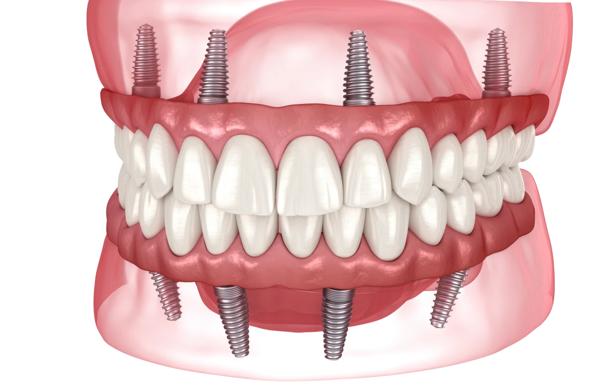all on 4 all on 6 dentistes ollioules All on 4 / All on 6 Dentistes Ollioules | Cabinet dentaire Mermoz