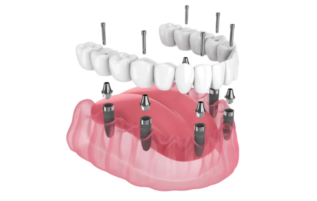 all on 4 dentistes ollioules All on 4 / All on 6 Dentistes Ollioules | Cabinet dentaire Mermoz