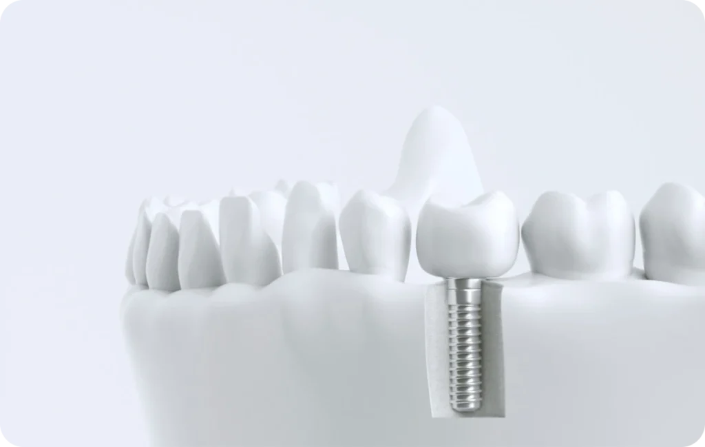 implant dentaire dentistes ollioules Dentiste Six Fours Dentistes Ollioules | Cabinet dentaire Mermoz