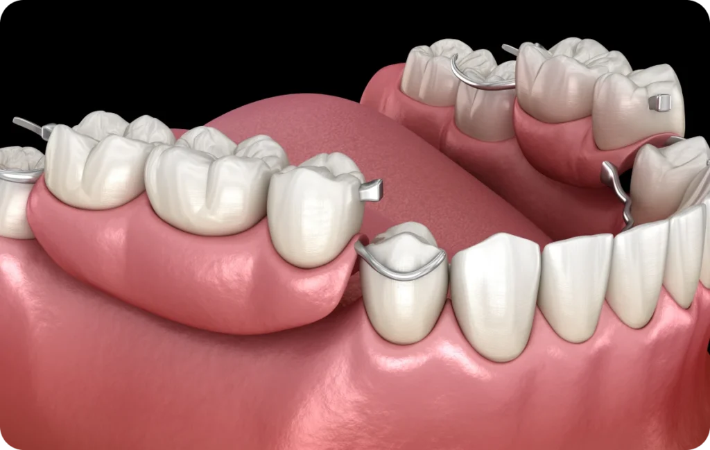 bridges dentistes ollioules Bridge Dentistes Ollioules | Cabinet dentaire Mermoz