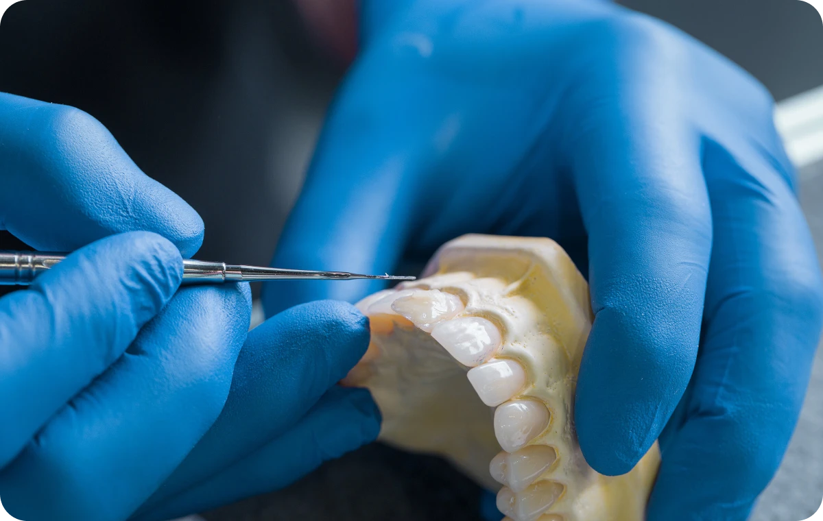 couronnes ceramiques dentistes ollioules Inlay / onlay  Dentistes Ollioules | Cabinet dentaire Mermoz