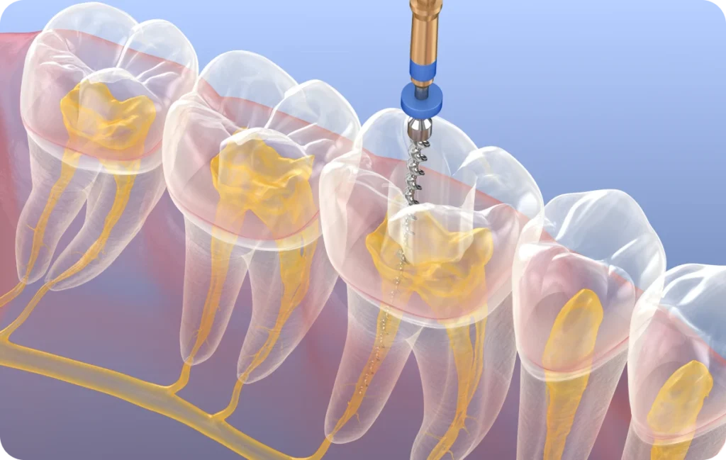 endodontie dentistes ollioules Traitement des racines Dentistes Ollioules | Cabinet dentaire Mermoz