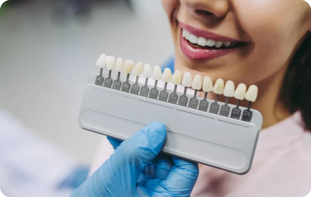 facettes dentistes ollioules Facettes dentaires  Dentistes Ollioules | Cabinet dentaire Mermoz