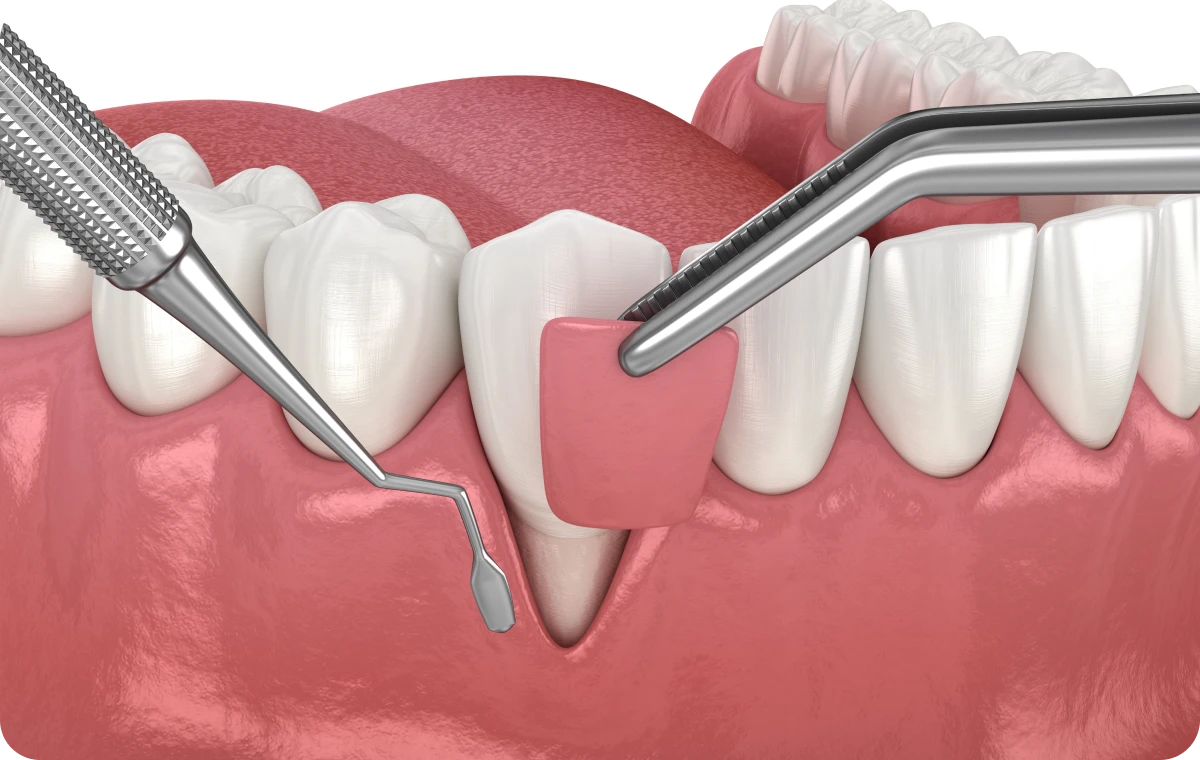 greffe gingivale dentistes ollioules Greffe de gencive Dentistes Ollioules | Cabinet dentaire Mermoz