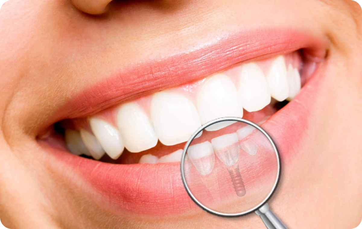 implant dentaire dentistes six fours  Dentistes Ollioules | Cabinet dentaire Mermoz